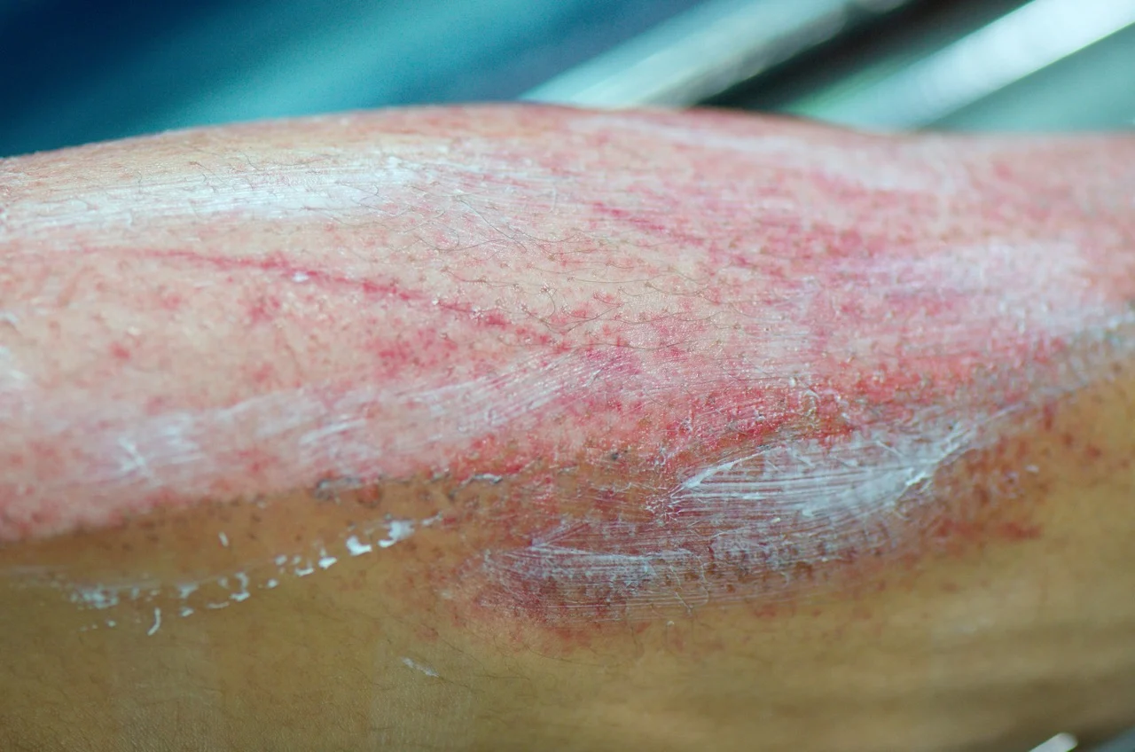 Friction burns treat by silver-nitrate.