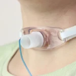 Tracheostomy in a adult woman